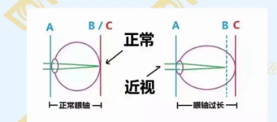 哪個(gè)年齡近視度數(shù)最容易增長？