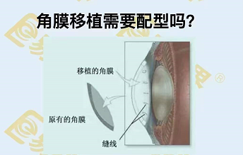 角膜移植需要配型嗎？