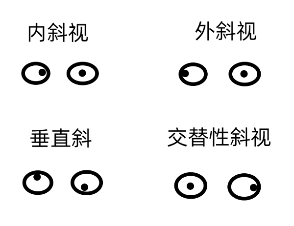 斜視早期的癥狀有哪些？